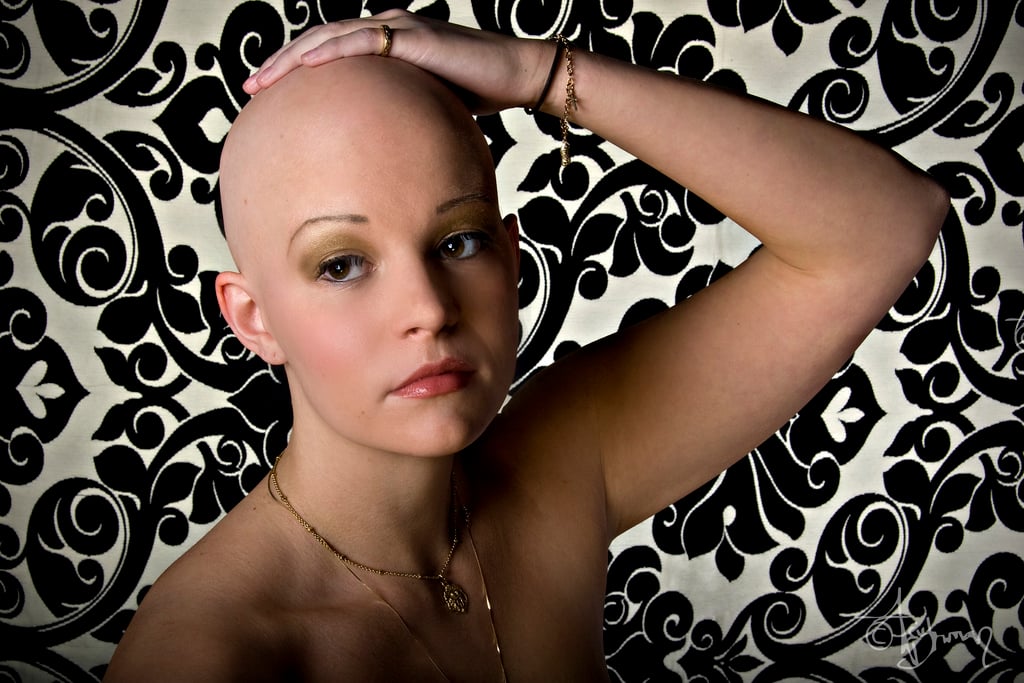 Bald woman with alopecia universalis.