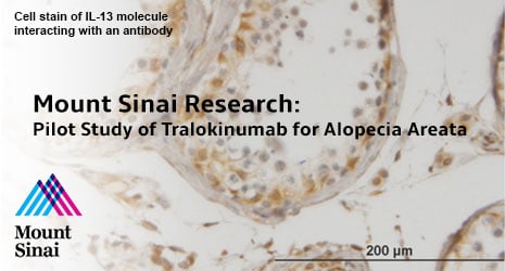 Pilot Study of Tralokinumab for Alopecia Areata Pilot Study of Tralokinumab for Alopecia Areata