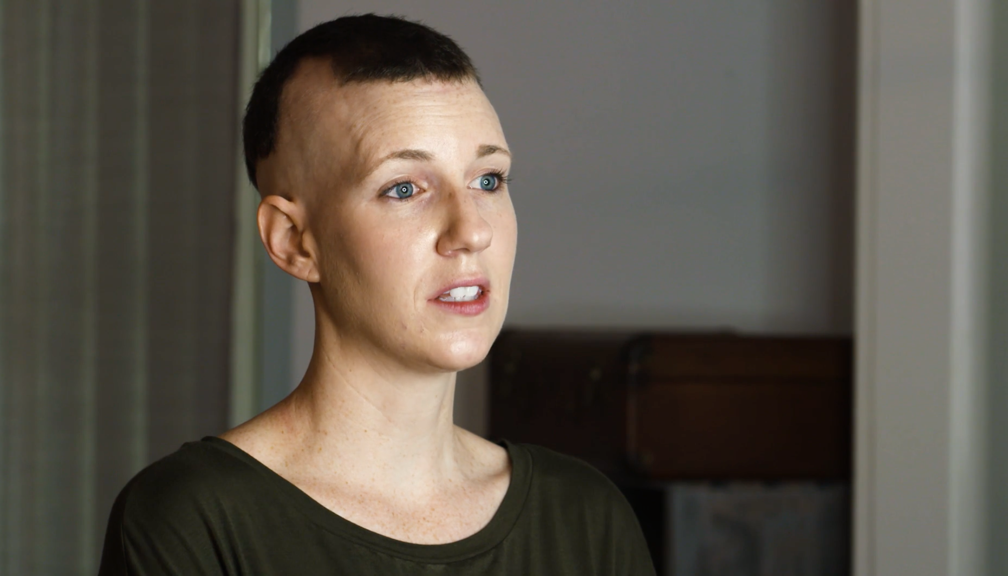 Shannon, living with Alopecia Areata